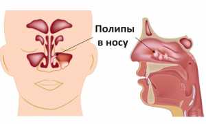 Причины и методы удаления полипов в носу