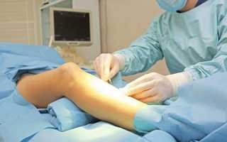 Когда проводят операцию на варикозное расширение вен на ногах?
