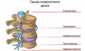 Грыжа грудного отдела позвоночника: лечение и симптомы