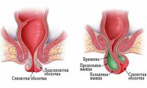Грыжа кишечника у женщин: диагностика и симптомы