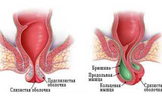 Грыжа кишечника у женщин: диагностика и симптомы