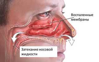Виды и лечение воспаления слизистой носа